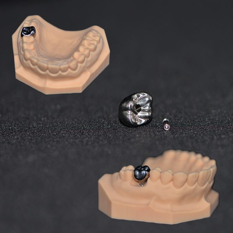 Implant&aacute;t PFM Monoblok Crown (Co-Cr)