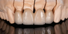 Taji za All-Ceramic &Zirconia