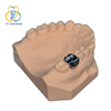 Implant&aacute;t PFM Monoblok Crown (Co-Cr)