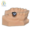 Implantat PFM Monobloc Crown (Co-Cr)