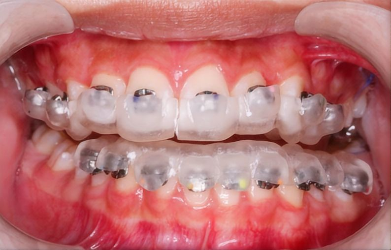 Step-by-Step Guided Surgery Workflow for Dental Implants (Clinic & Lab)