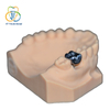 Implant&aacute;t PFM Monoblok Crown (Co-Cr)